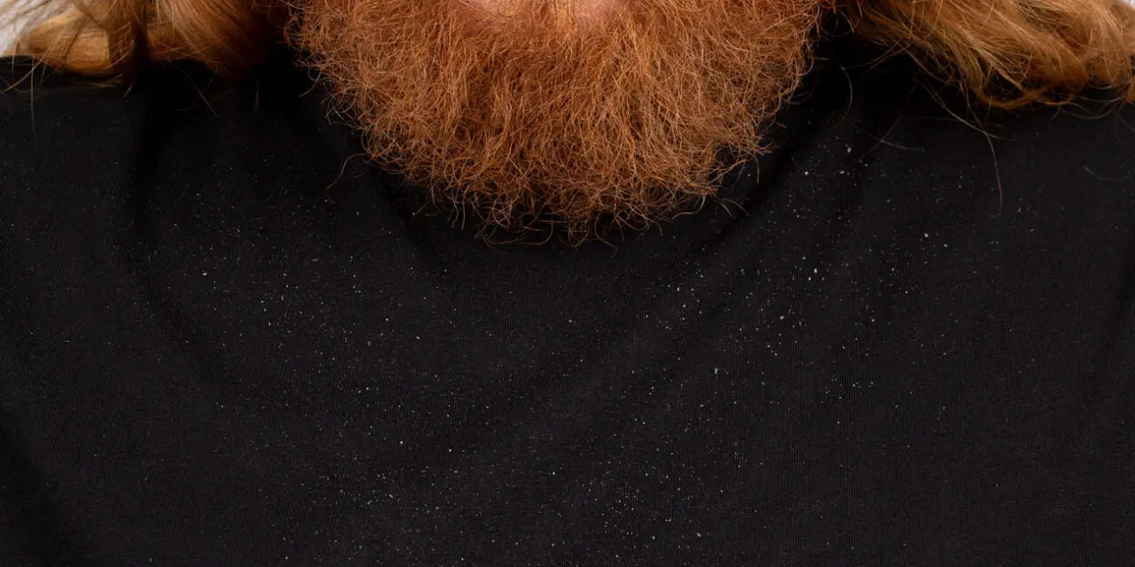 Beard Dandruff, Also Known As BeardDruff Derm Dude