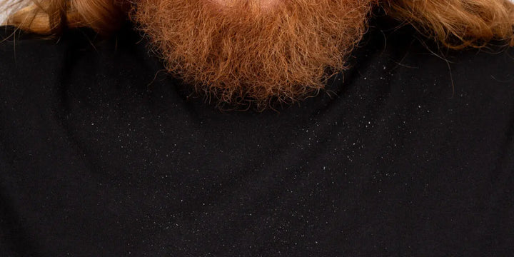 Beard Dandruff, Also Known As Beard-Druff Derm Dude