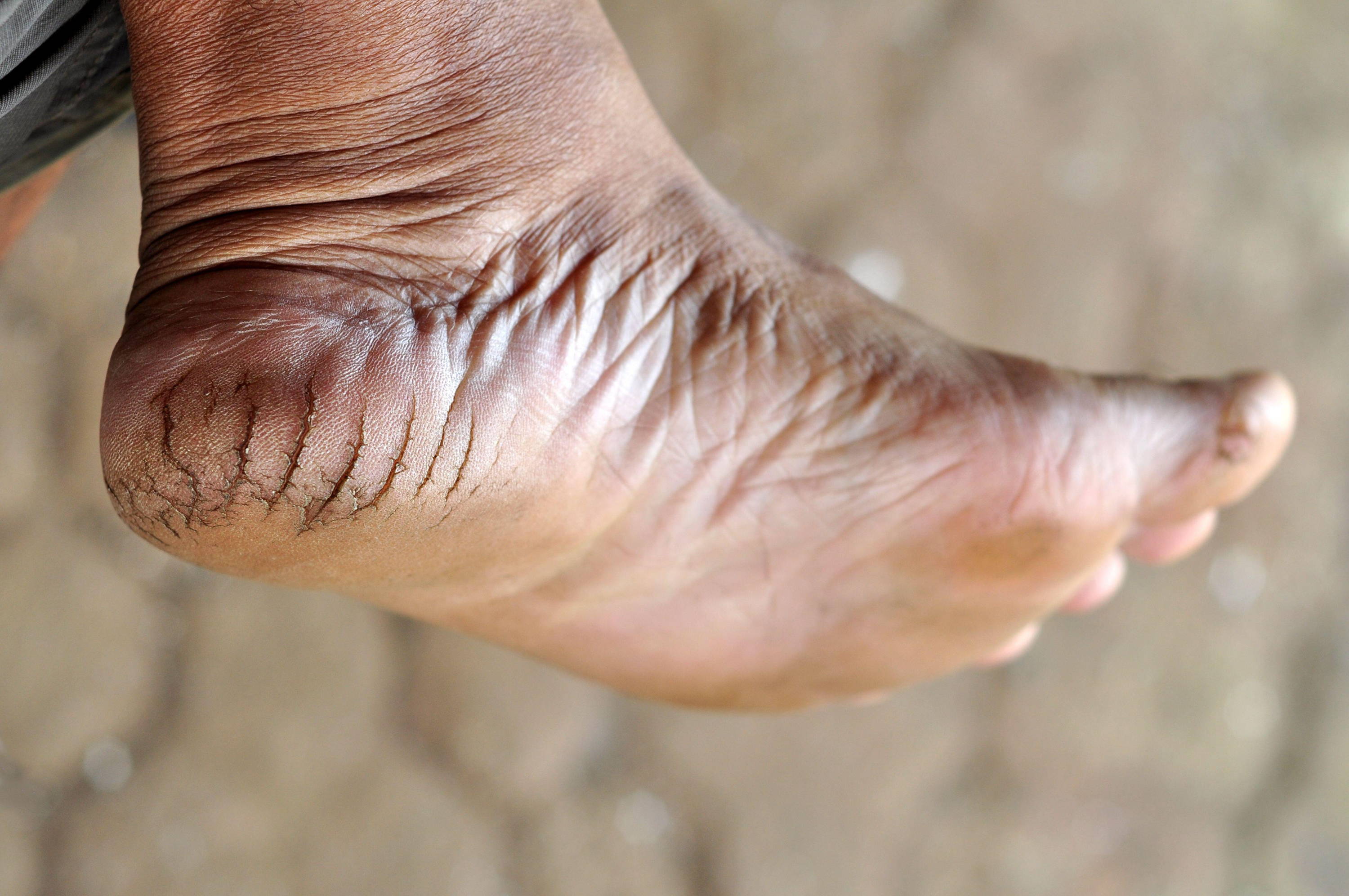 Painful Cracked Heels - Causes & Treatments for Heel Fissures
